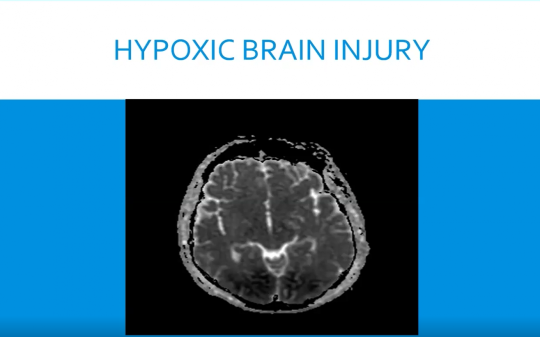 Dr Matthew Macfarlane – Hypoxic Brain Injury